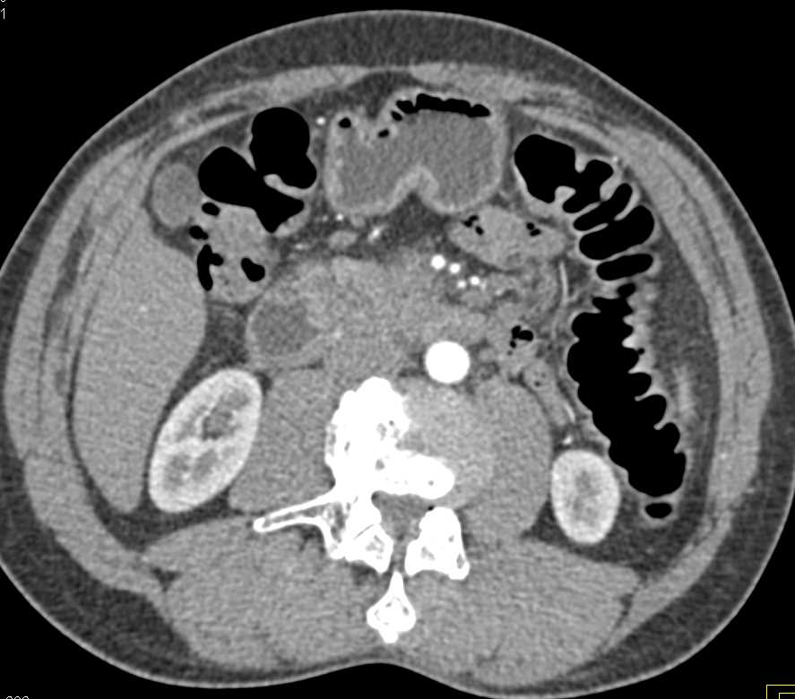 Pancreatic Cancer Encases the Superior Mesenteric Vein (SMV) - CTisus CT Scan