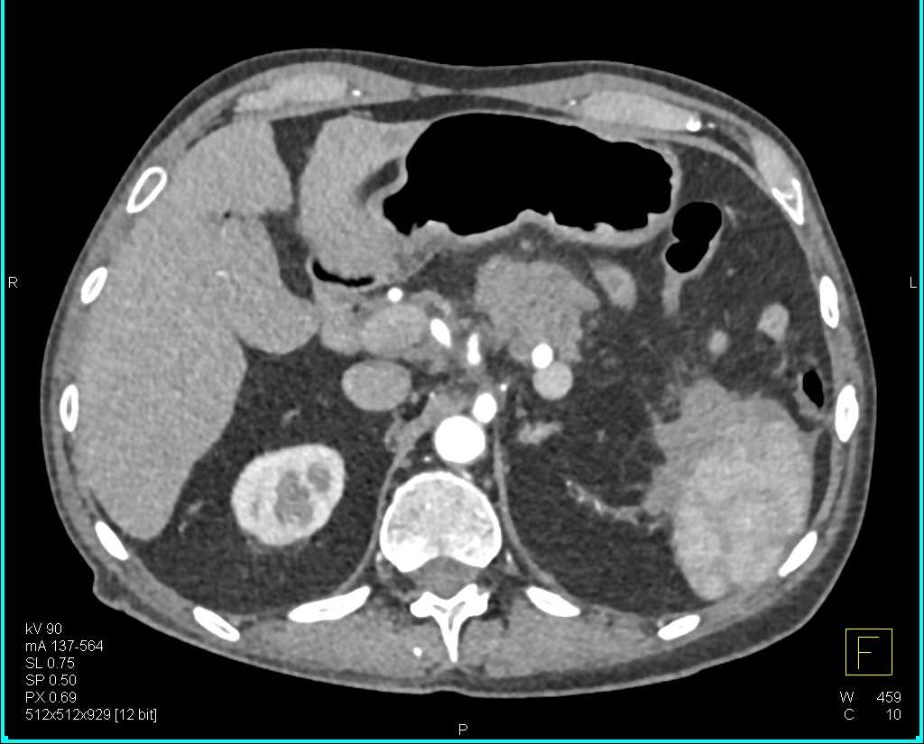 Carcinoma Tail of Pancreas Involves the Spleen - CTisus CT Scan