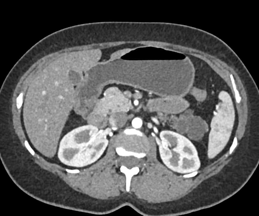 Mucinous Cystic Neoplasm (MCN) Tail of Pancreas - CTisus CT Scan