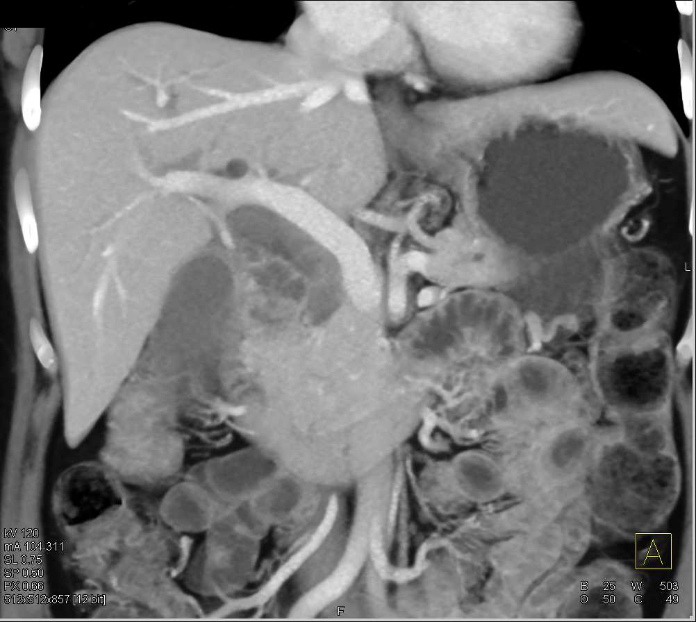 Carcinoma Head of Pancreas with Dilated Common Bile Duct - CTisus CT Scan