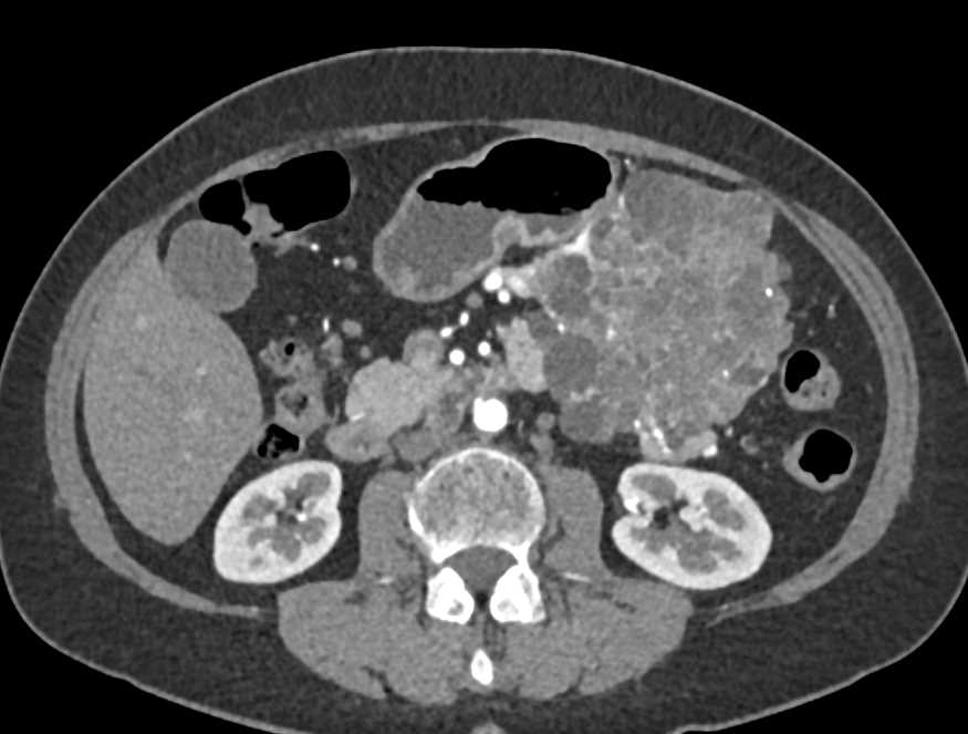 Serous Cystadenoma Tail of Pancreas - CTisus CT Scan