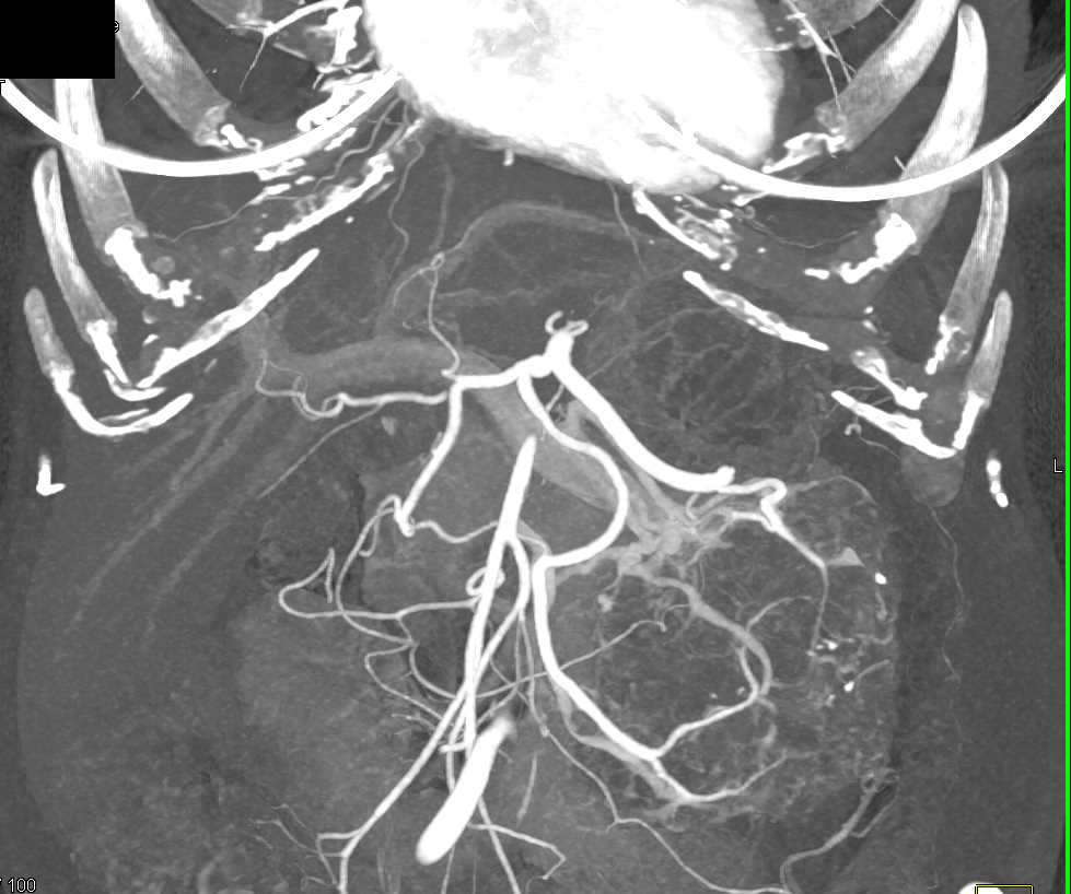 Serous Cystadenoma Pancreas - CTisus CT Scan