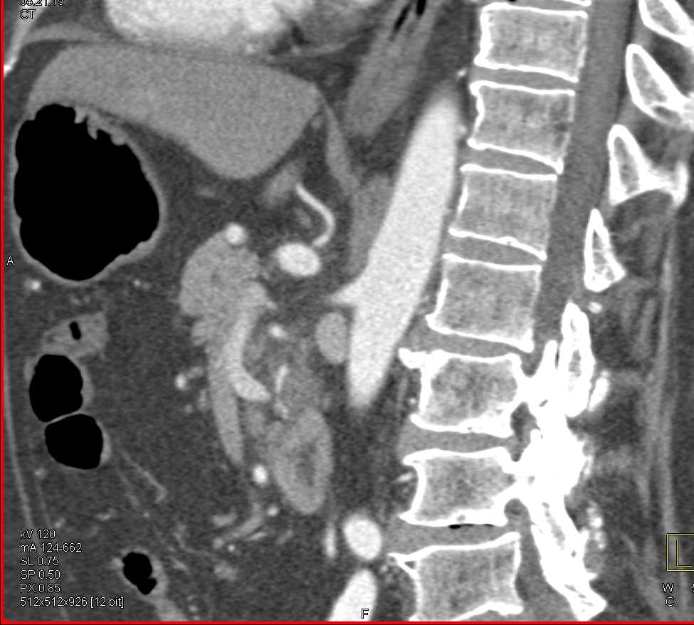 Pancreas Cancer Encases the SMA - CTisus CT Scan