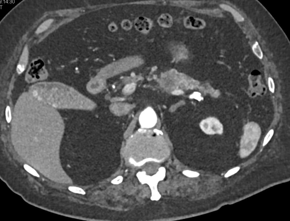 Pancreatic Cancer Arises from an IPMN - CTisus CT Scan