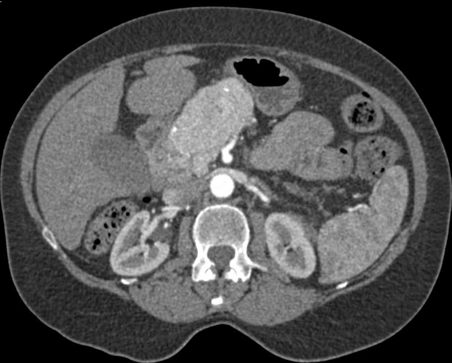 Neuroendocrine Tumor with CTPV - CTisus CT Scan