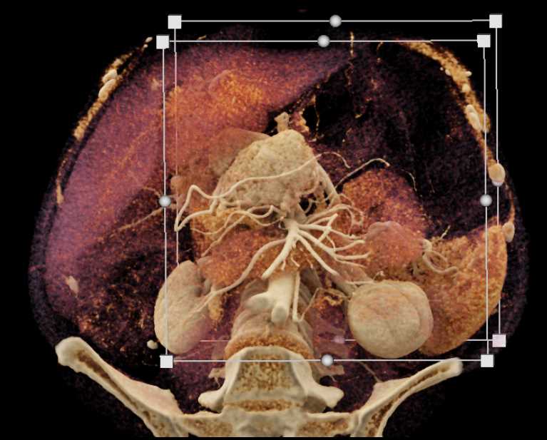Neuroendocrine Tumor with CTPV - CTisus CT Scan