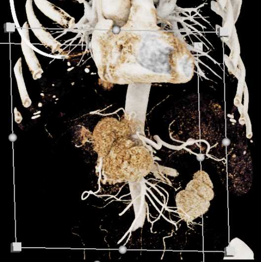 Neuroendocrine Tumor with CTPV - CTisus CT Scan