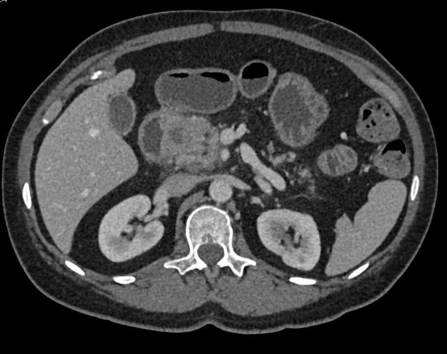 Pancreatic Adenocarcinoma Head of Pancreas - CTisus CT Scan