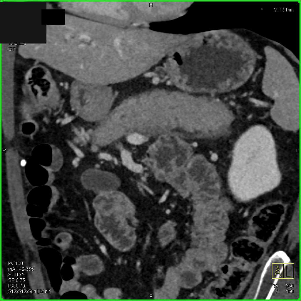 Autoimmune Pancreatitis - CTisus CT Scan