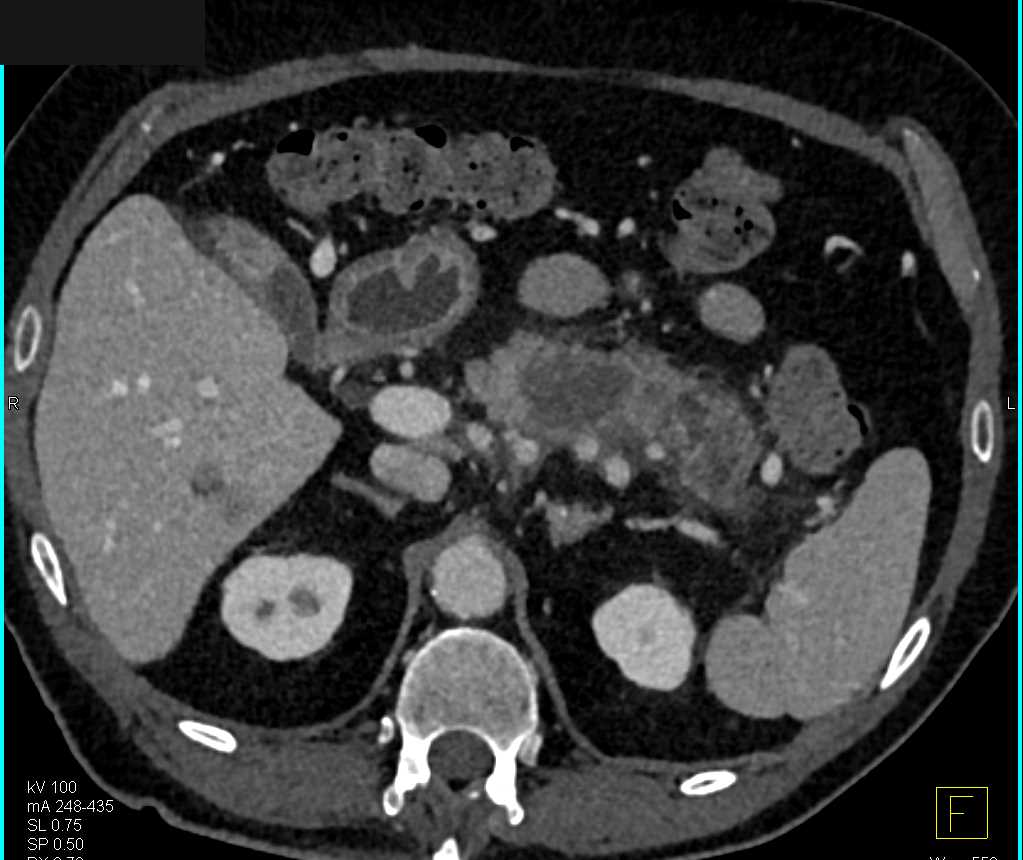Carcinoma Tail of Pancreas - CTisus CT Scan