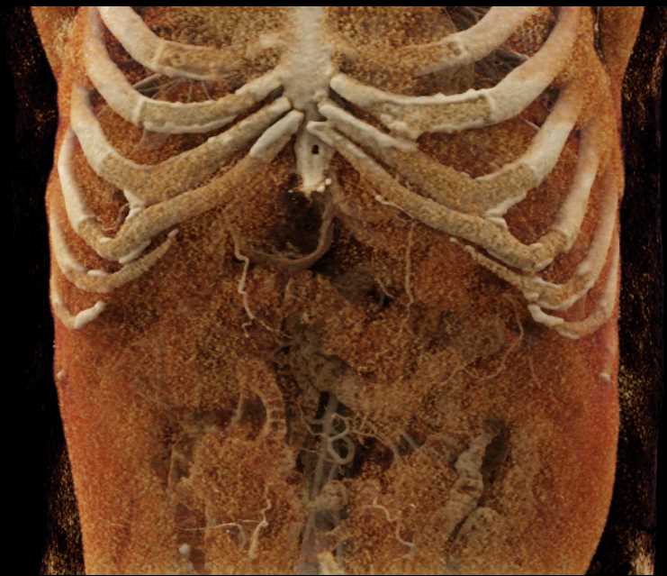 CTisus CT Scanning | Carcinoma Body of Pancreas with CR