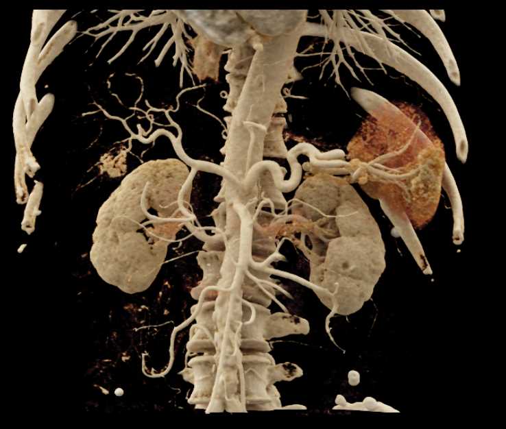 Carcinoma Body of Pancreas with CR - CTisus CT Scan