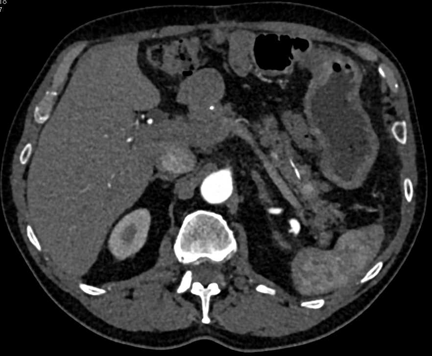 Contrast in the Pancreatic Duct - CTisus CT Scan
