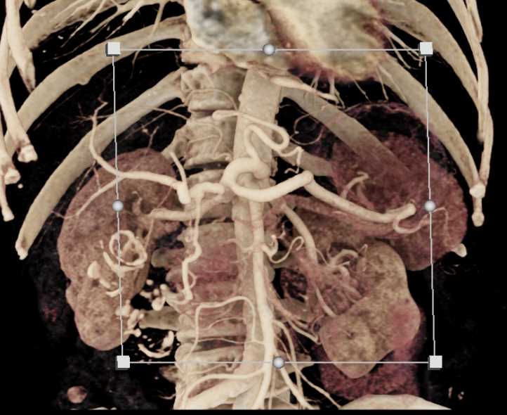 Carcinoma Head of Pancreas with Dilated Pancreatic Duct - CTisus CT Scan
