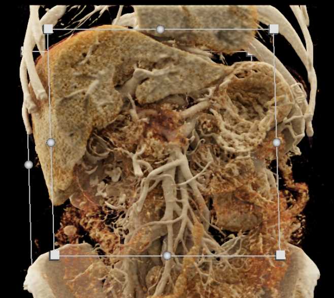 Pancreatic Adenocarcinoma - CTisus CT Scan
