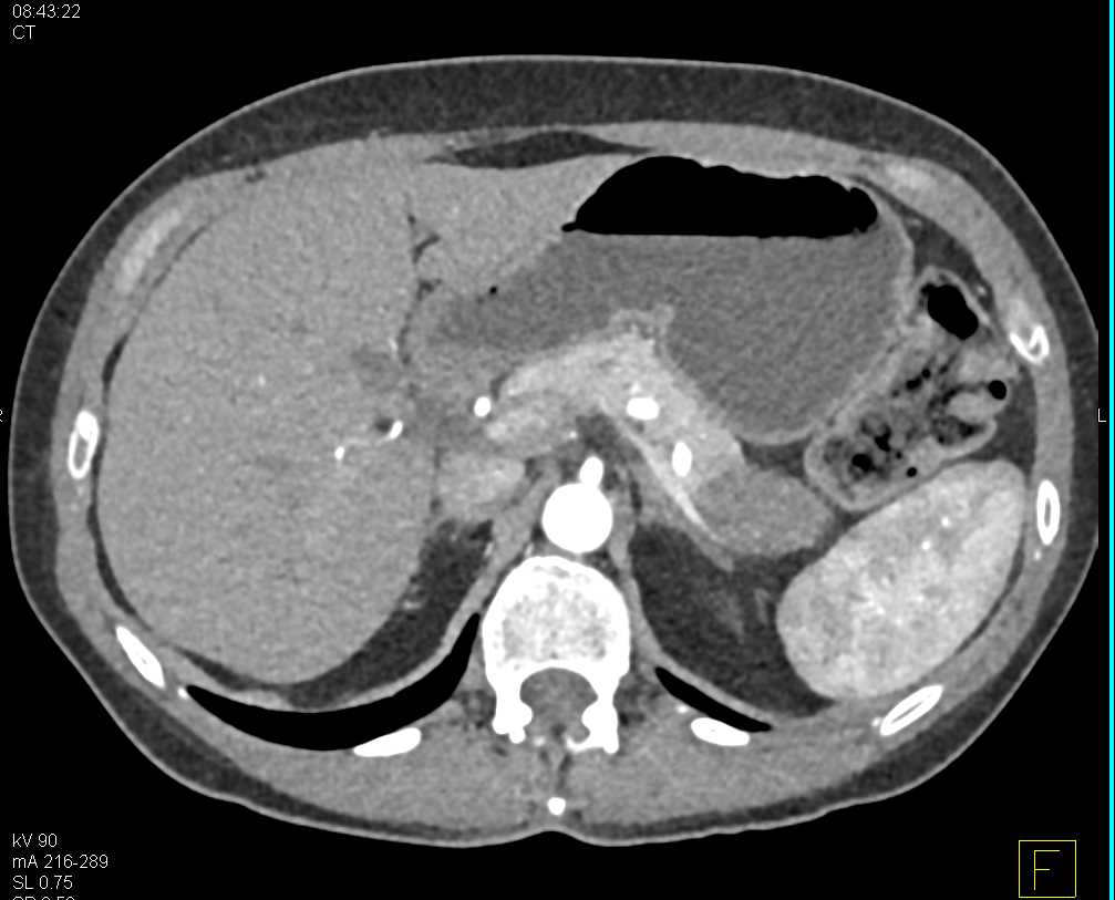 Adenocarcinoma Tail of Pancreas - CTisus CT Scan