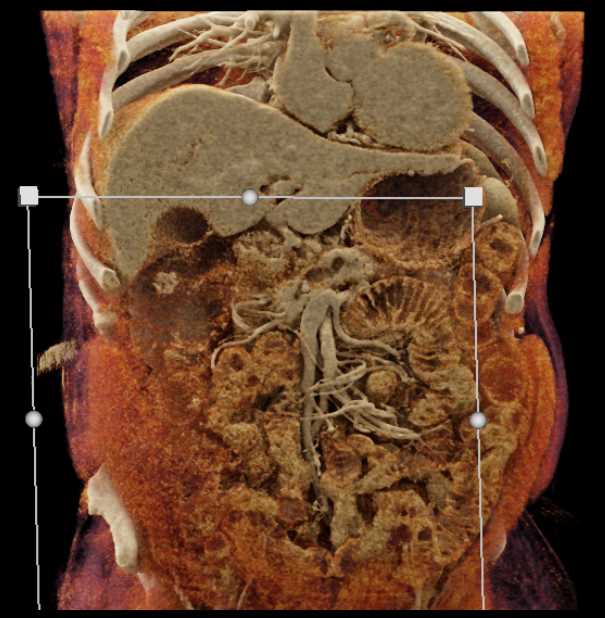 Carcinoma Head of Pancreas with Dilated Pancreatic Duct - CTisus CT Scan