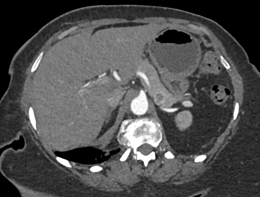 1cm Pancreatic Cancer - CTisus CT Scan