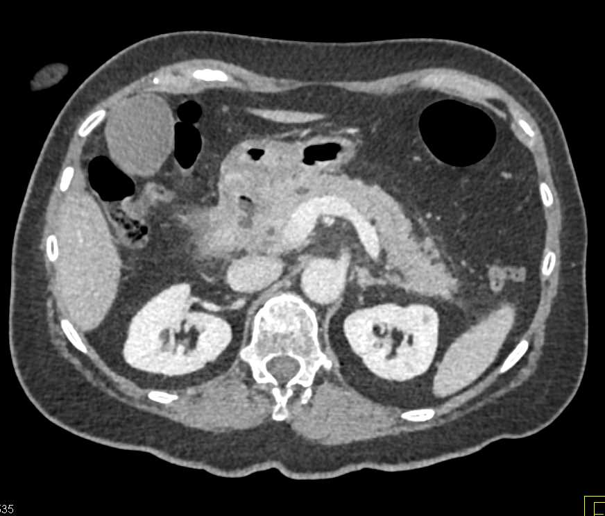 Acute Pancreatitis - CTisus CT Scan