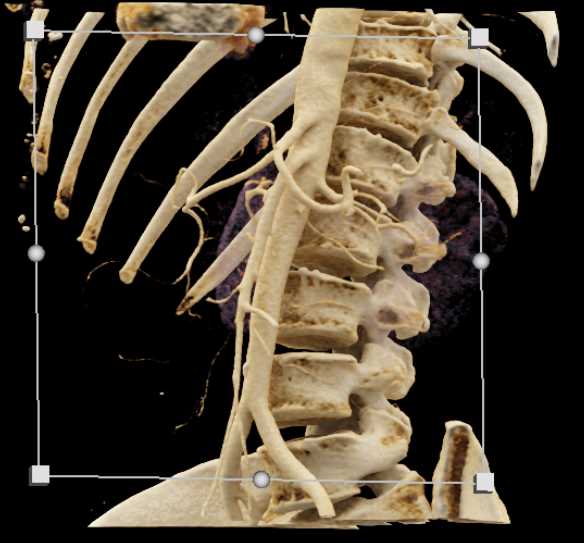 Carcinoma of the Pancreas - CTisus CT Scan
