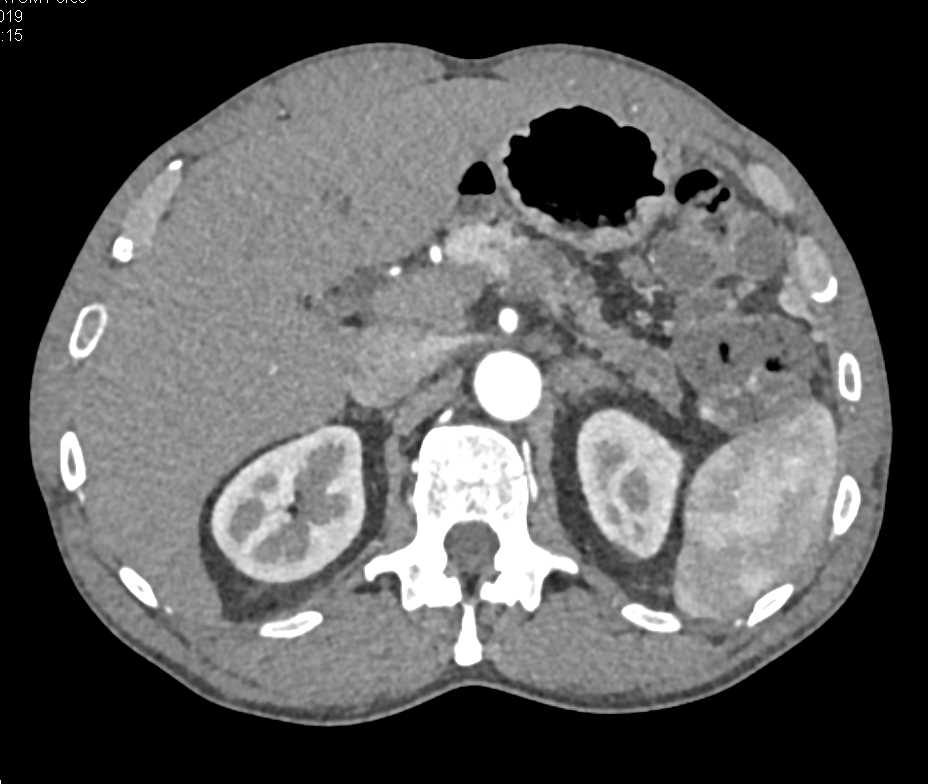 Carcinoma of the Body of the Pancreas - CTisus CT Scan