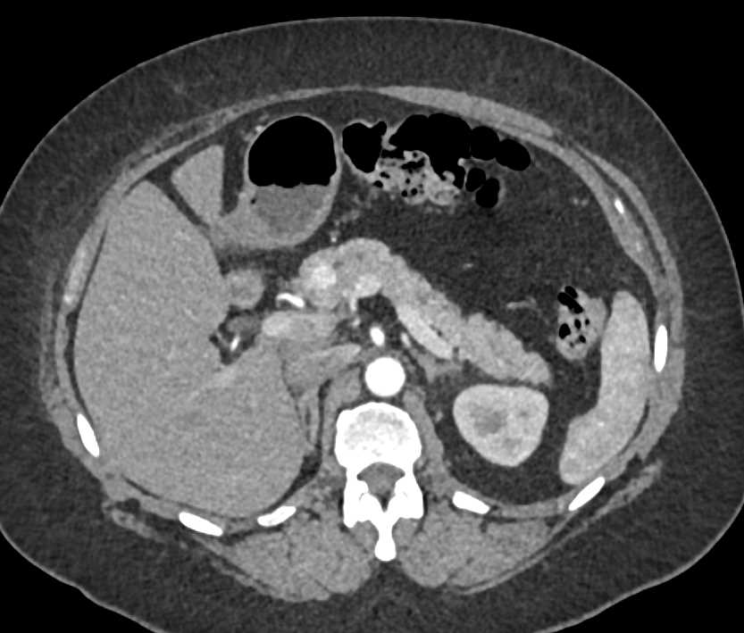 Renal Cell Carcinoma with Pancreas Metastases and Metastases to Contralateral Kidney - CTisus CT Scan