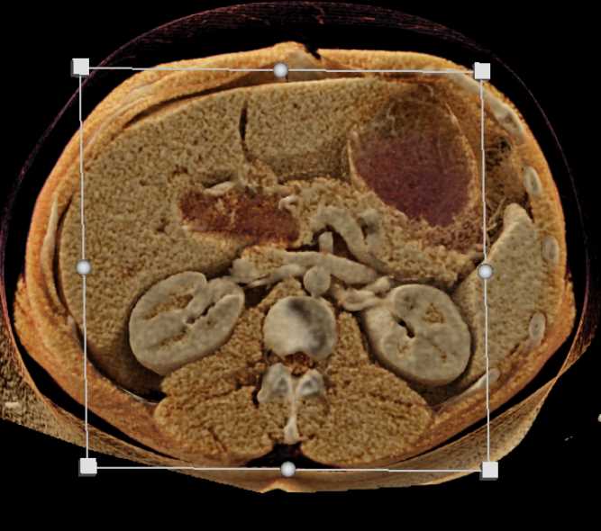 Dilated Common Bile Duct (CBD) with Carcinoma Head of Pancreas - CTisus CT Scan