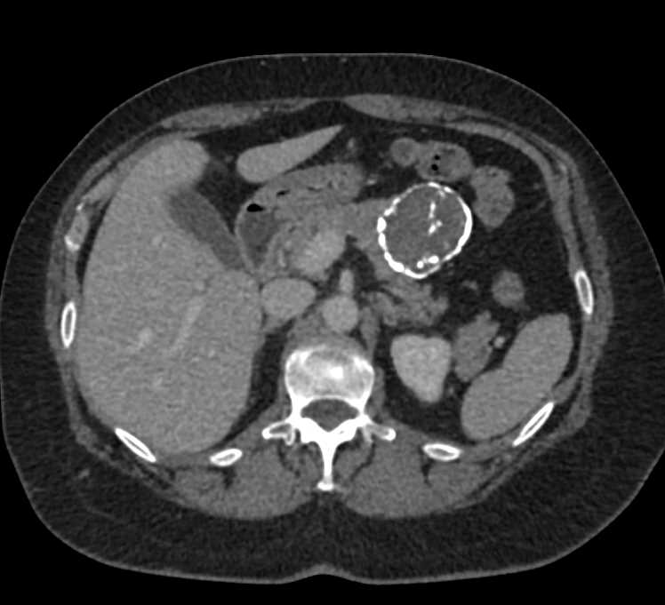 CTisus CT Scanning | Calcified SPEN Tumor