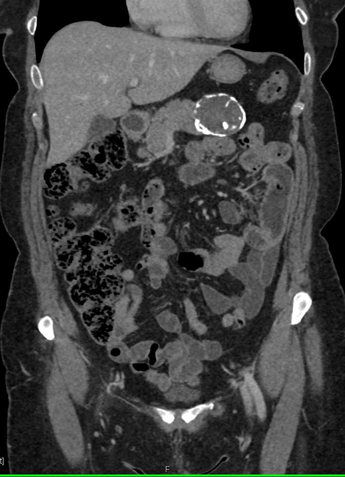 Calcified SPEN Tumor - CTisus CT Scan