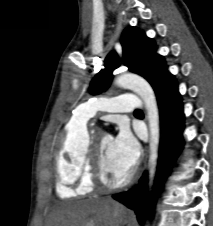 Complex Cardiac Anomalies with Aneurysm of Left Pulmonary Artery - CTisus CT Scan