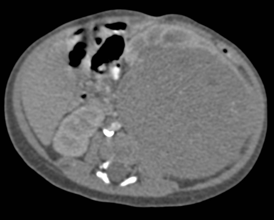 Wilms Tumor - CTisus CT Scan