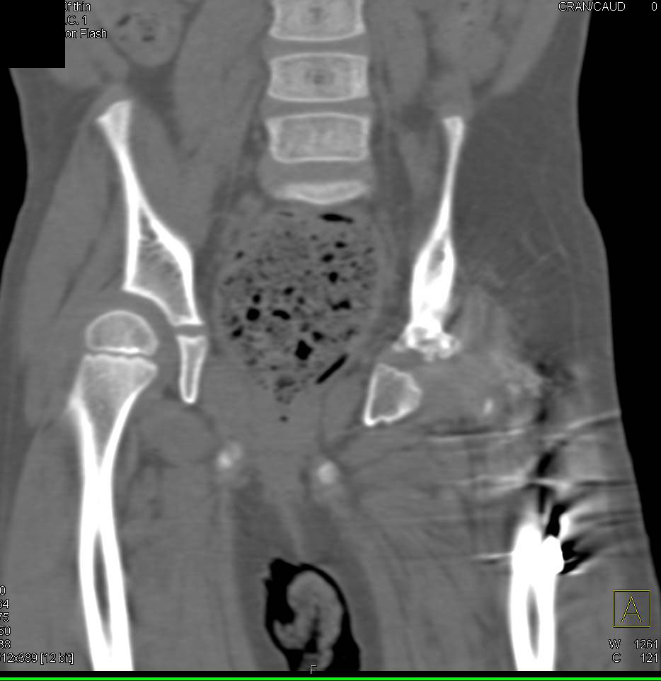 Dysplastic Hips with Extensive Surgery with Reconstruction of the Left Acetabulum and Femur - CTisus CT Scan