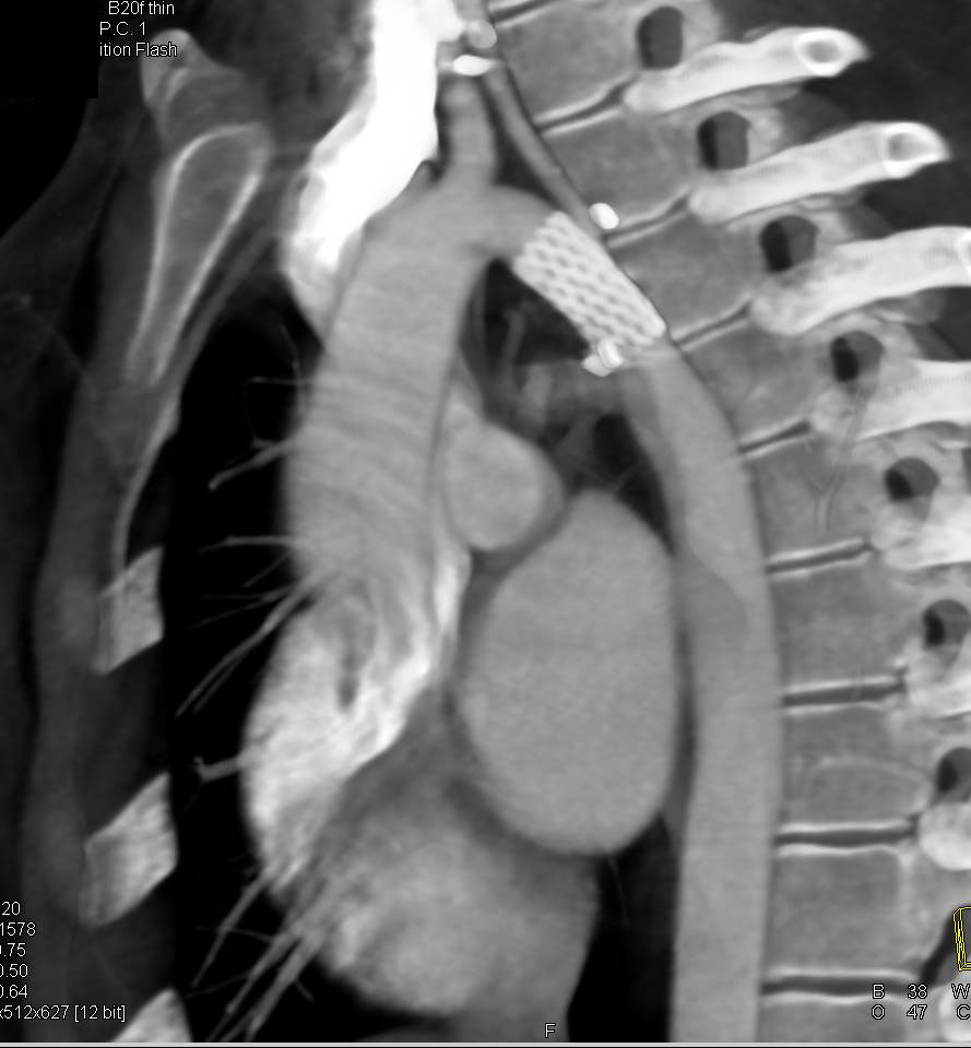 Endovascular Stent Repair of Coarctation of the Aorta - CTisus CT Scan