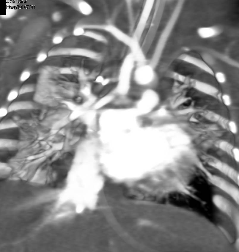 3D Mapping of a BT Shunt - CTisus CT Scan