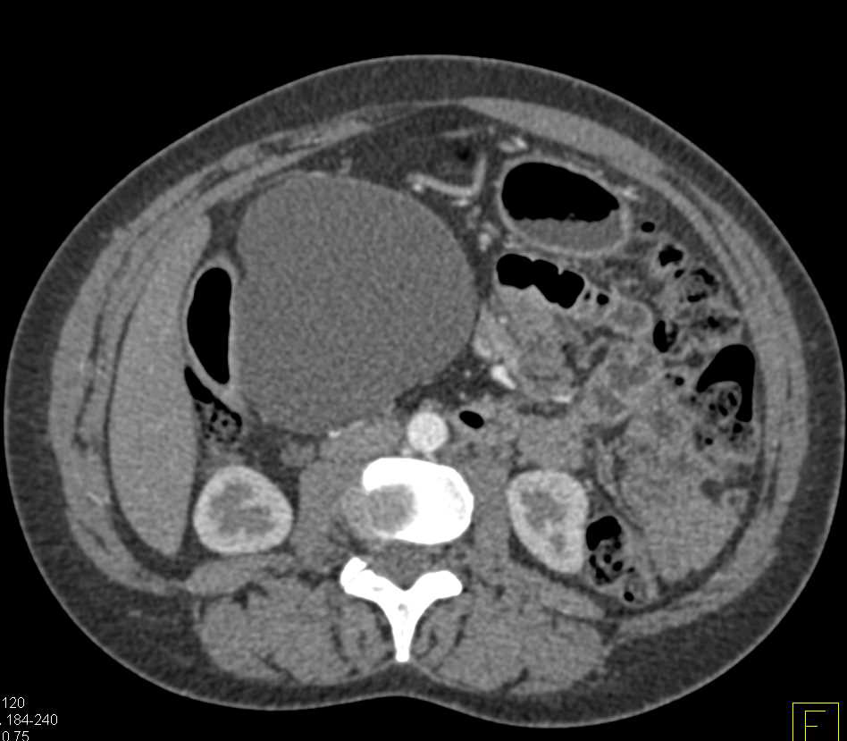 Cystic Lesion in Head of the Pancreas in a Patient with Cystic Fibrosis - CTisus CT Scan