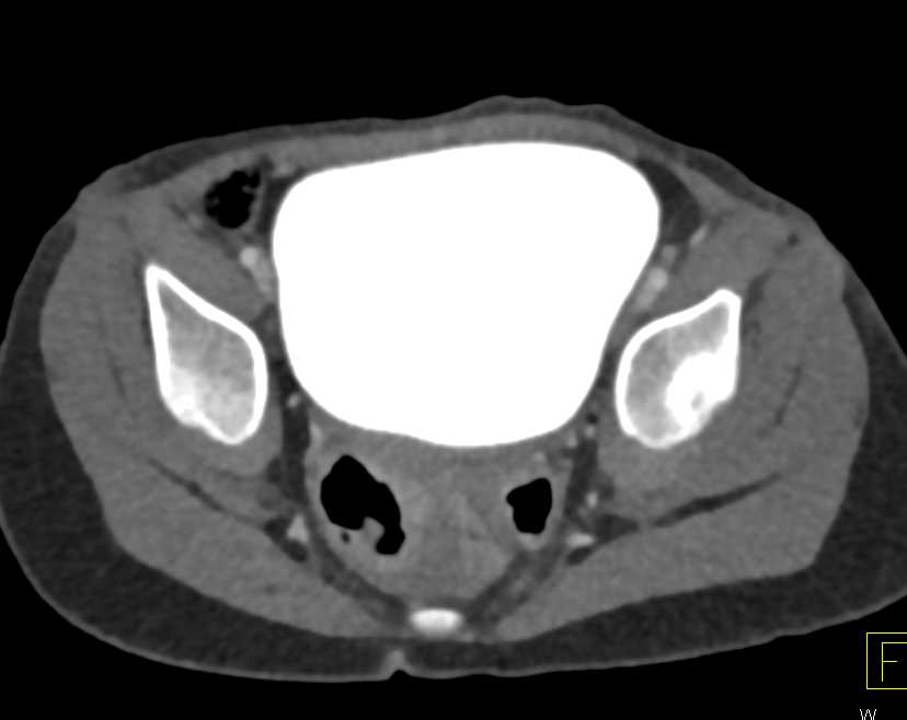 Subtle Sacral Fracture Without Bladder Injury - CTisus CT Scan