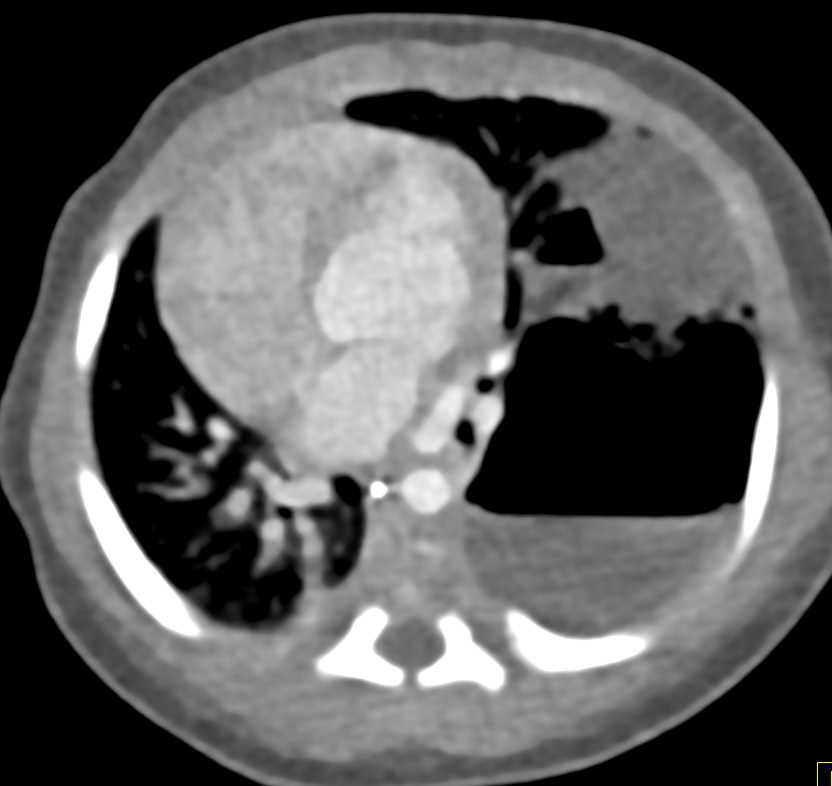 Cystic Adenomatoid Malformation Left Lung with Abscess - CTisus CT Scan