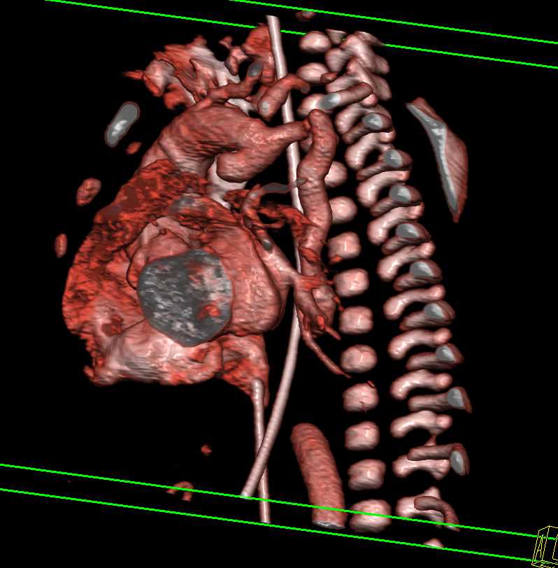 Coarctation of the Aorta - CTisus CT Scan