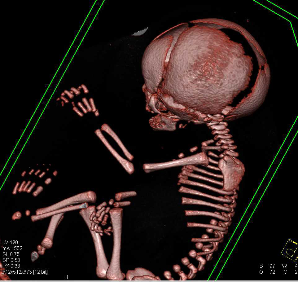 CT Evaluation of Fetus for Suspected Cranial Stenosis - CTisus CT Scan