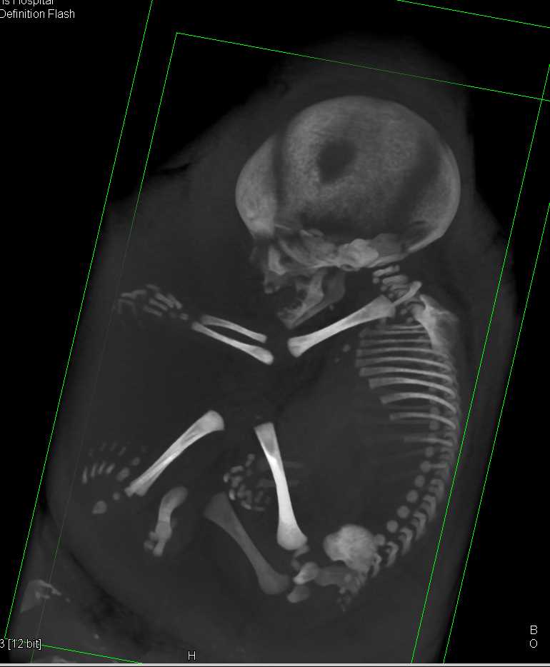 CT Evaluation of Fetus for Suspected Cranial Stenosis - CTisus CT Scan