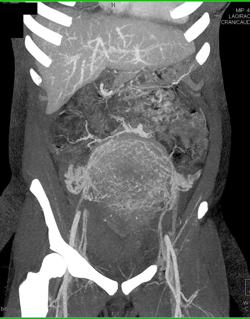 Postpartum Uterus - CTisus CT Scan
