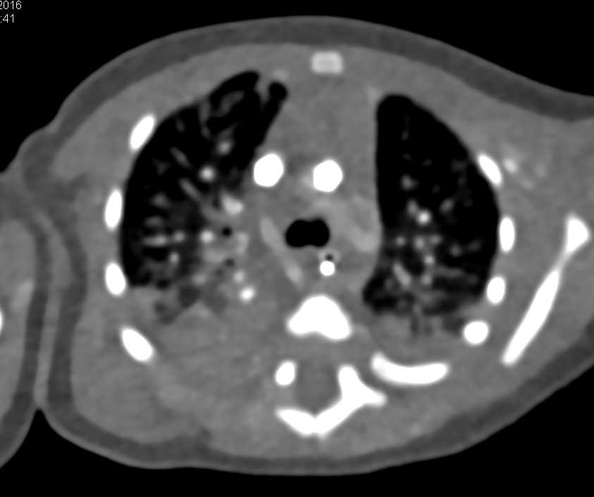 Aspiration Pneumonia in Patient with Congenital Heart Disease - CTisus CT Scan