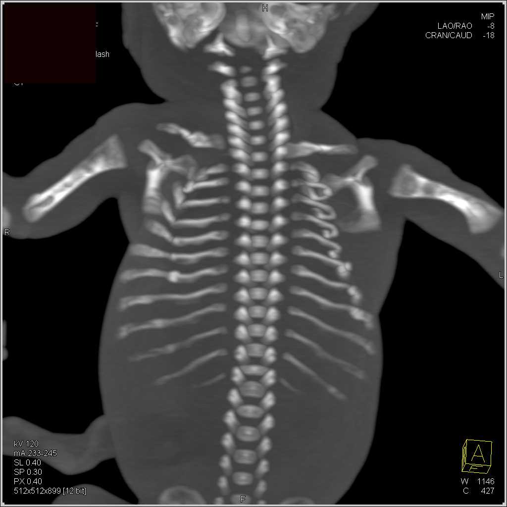 Osteogenesis Imperfecta - CTisus CT Scan