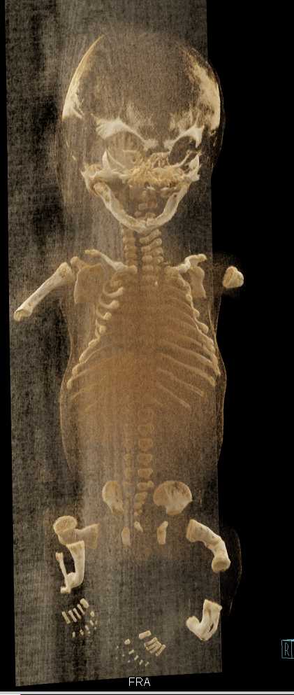 Osteogenesis Imperfecta - CTisus CT Scan