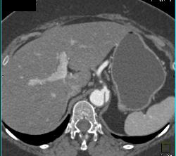 Dissection Involves the SMA - CTisus CT Scan