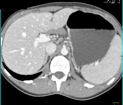 Fluid Lesser Sac Due to Prior Pancreatitis - CTisus CT Scan