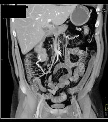 Inflammatory Bowel Disease (IBD) With Nice Vasa Recta - CTisus CT Scan