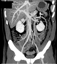 Inflammatory Bowel Disease (IBD) With Nice Vasa Recta - CTisus CT Scan