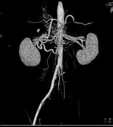 Dilated Gastroduodenal Artery (GDA) Due to Median Arcuate Ligament Syndrome With Celiac Stenosis - CTisus CT Scan