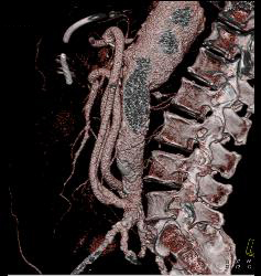 Mesenteric Bypass Grafts - CTisus CT Scan